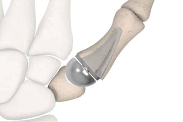 What Is Joint Replacement?